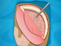 Online Game Operate Now: Epilepsy Surgery